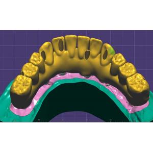 Профессиональный зубоврачебный дизайн кроны имплантирует и наводит 3 форму Exocad