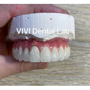 Implant Metal Ceramic Dental Bridges Screwed Retained With Stump