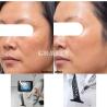 China 500W High Power ND YAG Laser Device for Skin Rejuvenation , Portable Solid State ND YAG Laser for Red and Brown Pigment Clearance wholesale
