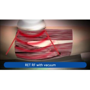 LCD ディスプレイ Physio Tecar Indiba Diathermy Machine Cet Ret 448khz