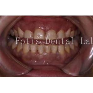 Customization Porcelain Teeth Veneers With Smooth Surface Texture