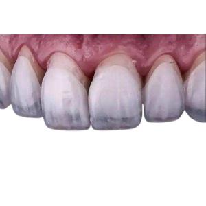 Dental Lab Dental Veneers Dentures Restorative Zirconia Crown Veneers