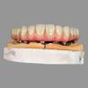 China Class I AOX Implants All On 4 Hybrid Titanium Screw Retained Full Zirconia wholesale