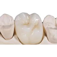 China White Porcelain Zirconia Dental Crown High Density Unobstructed on sale