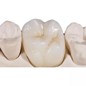 White Porcelain Zirconia Dental Crown High Density Unobstructed