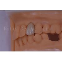 China 3 Shape/Exo Design Digital Dental Crowns Better Fit And Less Discomfort on sale