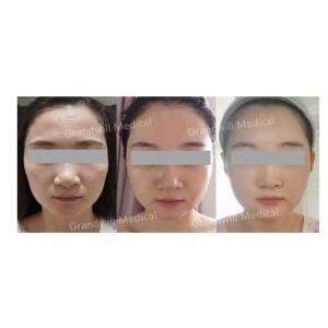 Hyaluronic Acid PCL Skin Booster Miracle Touch Up Skin Collagen Stimulator