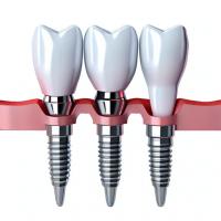 China Prioritizing Patient Satisfaction Our Commitment To Quality Dental Implant Crowns on sale