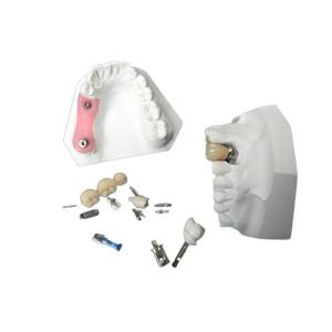 High Durability Zirconia Dental Implant Crown For Dental Restoration