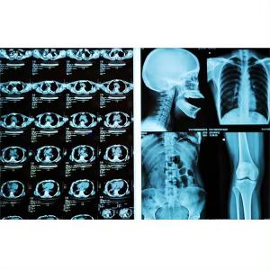 Medical X Ray Film Blue Film For FUJI Agfa Thermal Printers