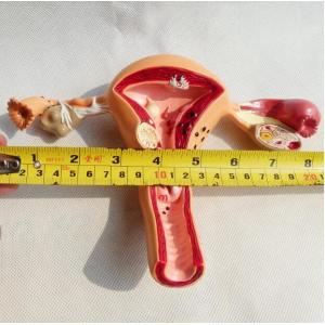 Female Anatomical Model Pathological Uterine Vagina Genitourinary