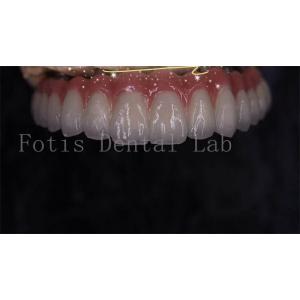 Modern Seamless Integration Implant Retained Crown Easy To Clean