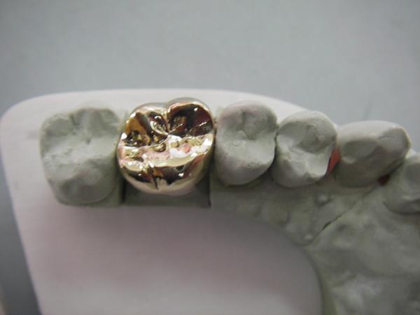 Full Metal PFM Dental Crown Bridge High Tech Biological Material