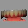 China Clase 2 Hybrid Malong Full Arch AOX Implant Bridge Barra de titanio con zirconio sólido completo wholesale