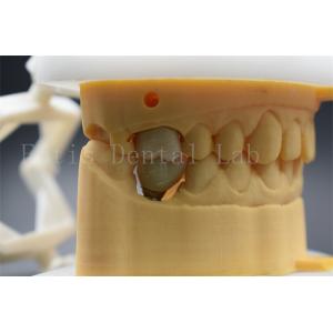 Customizable Dental Implant Abutment Crown Comfortable For Patients