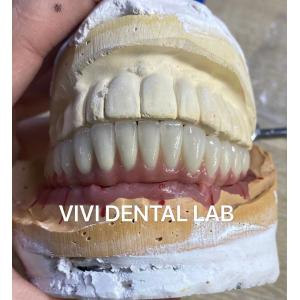 Dental Implant Metal Ceramic Bridge On Titanium Abutments