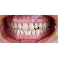 China Cosmetic Dentistry Dental Porcelain Veneers With High Stain Resistance on sale