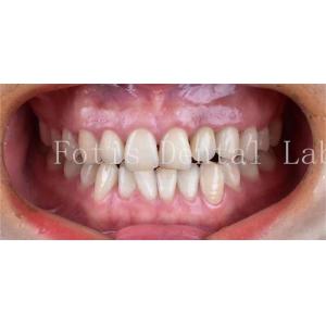 Cosmetic Dentistry Dental Porcelain Veneers With High Stain Resistance