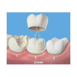 China No Allergies Biocompatible Transition Dental Crowns And Bridges With Quick Solution wholesale