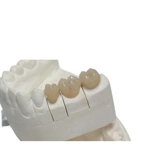 Temporary CAD / CAM PFM Dental Crown 3D Printing Design Denture Customization