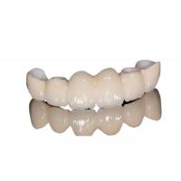 China Corrosion Resistant Porcelain Dental Crown Natural Appearance For Front Teeth / Back Teeth on sale