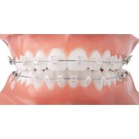China Easy Clean Orthodontic Ceramic Bracket Beautiful Fixed Orthodontic Appliances on sale