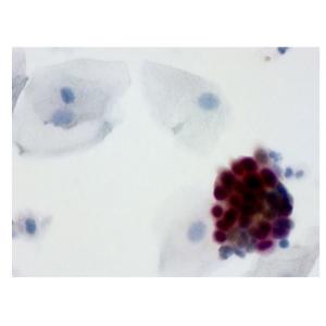 Immunoassay Powerful Biomarkers IHC Staining Kit For Cervical Cancer Screening