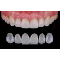China Tranlucent Emax Laminate Veneers / Porcelain Dental Veneers ISO Approved on sale