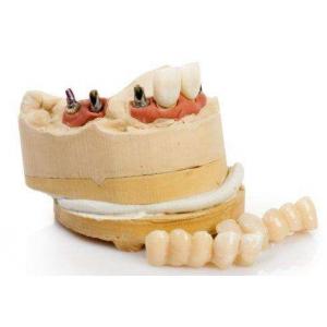 Customized Dental Implant Replacement Durable Titanium Dental Implant