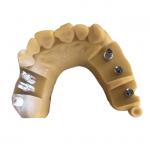 Digital Biocompatibility PFM Dental Crown 3D Printing Temporary Crowns