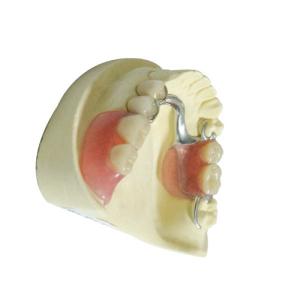 Professional Dental Lab Products Acrylic Removable Partial Dentures