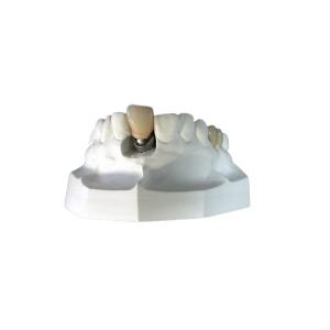 Custom Dental Implant Locators High Stability Bar Attachment Denture