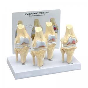 PVC Transparent Human Stage 4 Knee Pathology Joint Model For Studying