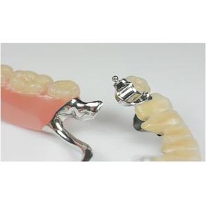 Removable Precision Attachment Partial Denture Stable Professional