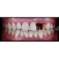 China Customised Natural Temporary Dental Veneers For A Beautiful Smile on sale