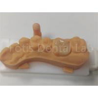 China Dental Restorations Ceramic Inlay And Onlay For Long Lasting on sale