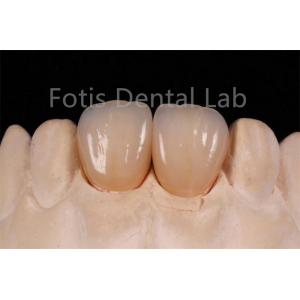 High Translucency Multi Layer Zirconia For Fabrication Of Dental Restorations