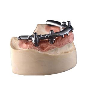 High-Density PFM Dental Implants Dentures Strong Hardness Long Lasting​