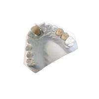 China Yellow Gold Porcelain Dental Crown OEM High Strength New Condition on sale