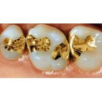 China Gentle Dental Inlay Onlay Crowns 74% Gold Inlays And Onlays on sale