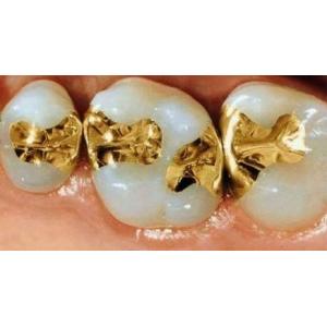 Gentle Dental Inlay Onlay Crowns 74% Gold Inlays And Onlays