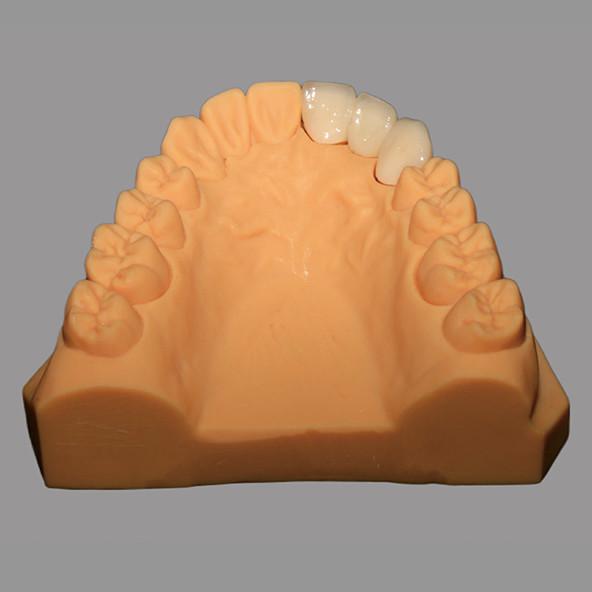 Biocompatible Full Ceramic PFZ Bridge With CAD / CAM System