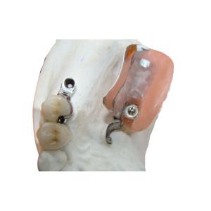 Dental Lab Long Lasting Precision Attachment Denture Stain Resistant