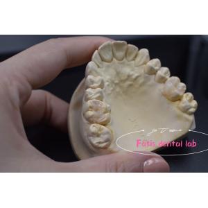 Effective E.Max / Composite Inlays And Onlays For Repair Damaged Or Decayed Teeth