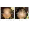 300 Watts Clinic Laser Treatment For Hair Loss , Low Level Laser Therapy Hair