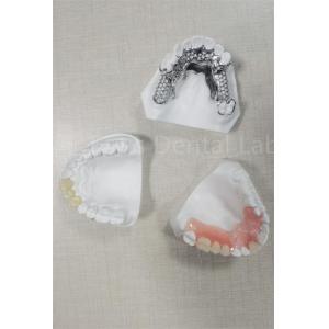 Long Lasting Flexible Removable Partial Denture Easy Cleaning Replace Missing Teeth