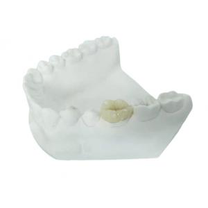 Durable FDA All-Ceramic Dental Crown Veneer Inlay Onlay Similar