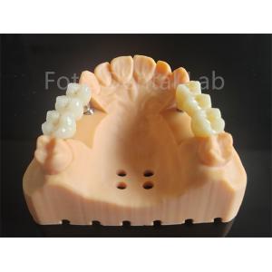 Customized Full Contour Zirconia Layered With Porcelain Dental Material