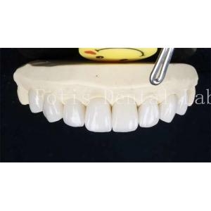 0.3-0.5mm Ceramic Laminate Teeth False Teeth Veneers With Adhesive Bonding Cement