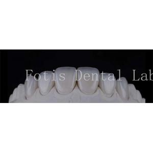 Smooth Polished Ceramic Laminate Veneers In Dentistry Smile Creators